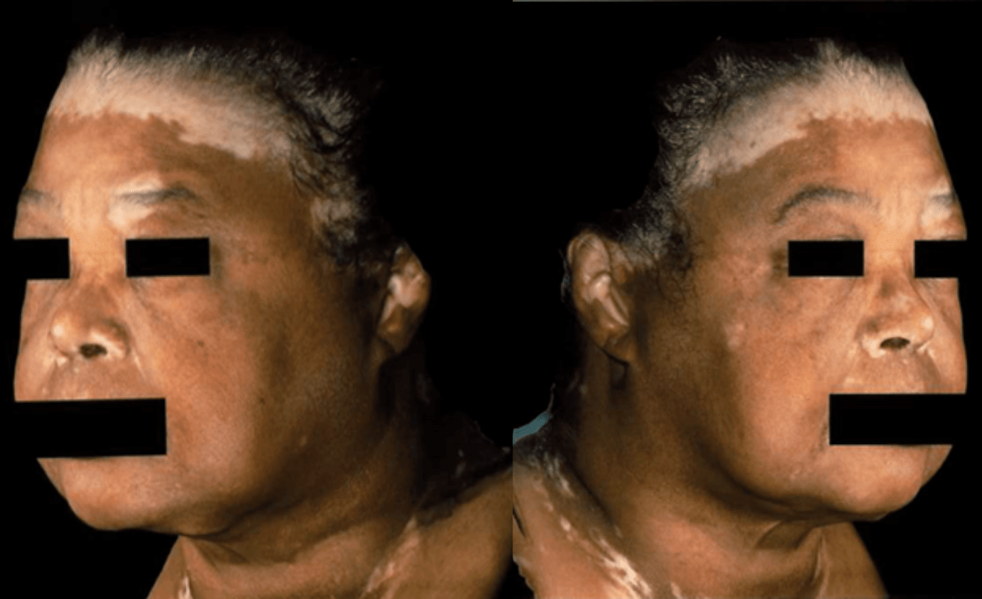 A Case of Nonsegmental Vitiligo on the Face and Hands Treated With Combination Topical JAK Inhibitor and Phototherapy