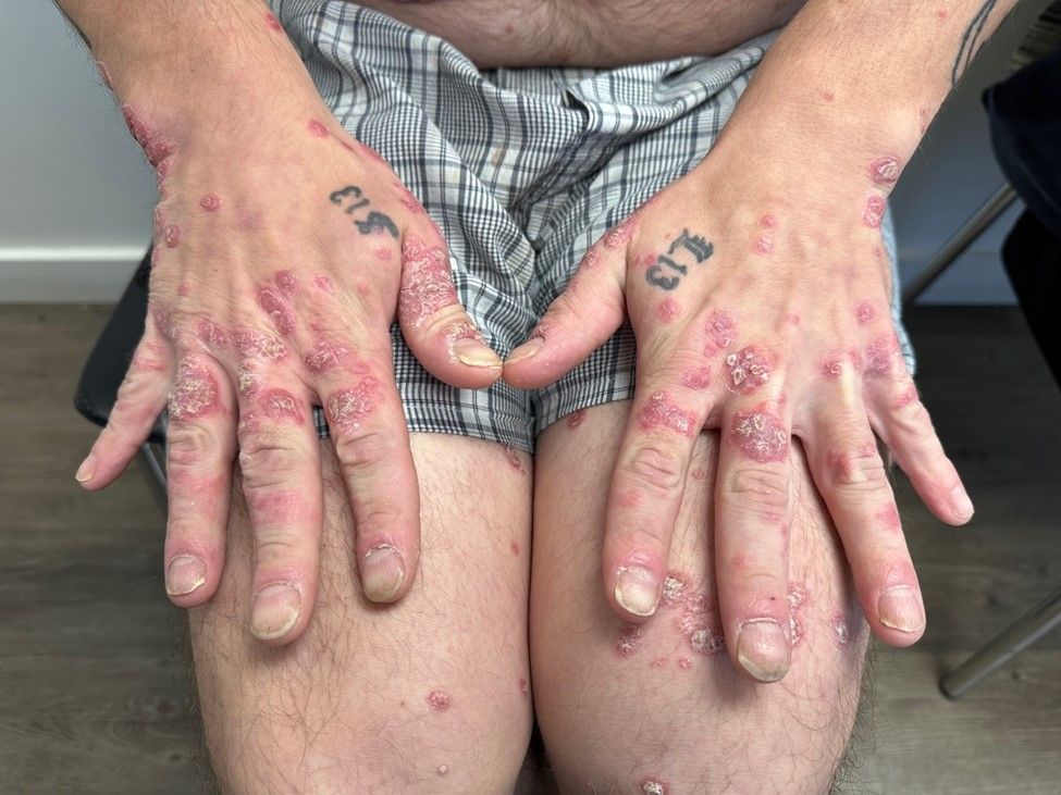 Rapid and sustained clearance of severe psoriasis with dual inhibition of IL-17A and IL-17F