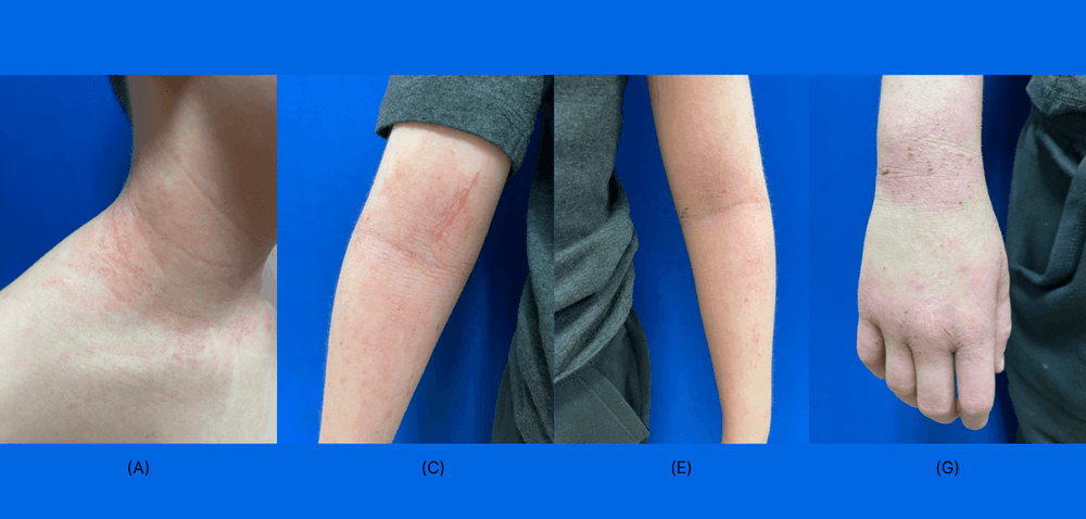 Utility of Tapinarof Cream 1% in a Case of Severe and Recalcitrant Atopic Dermatitis In a Pediatric Patient