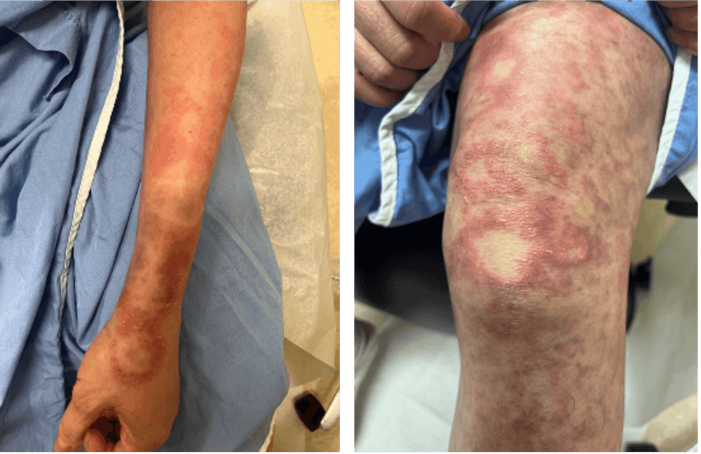 Subcutaneous Spesolimab Use in a Patient with Chronic Recurrent Generalized Pustular Psoriasis (GPP)