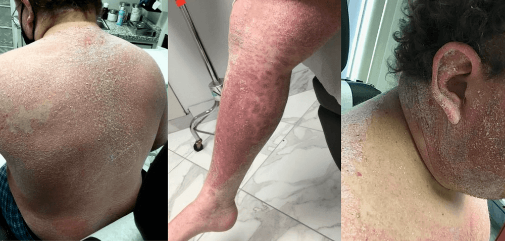 A Remarkable Result after a Lifetime of Disappointment in the Treatment of Severe, Recalcitrant Psoriasis 