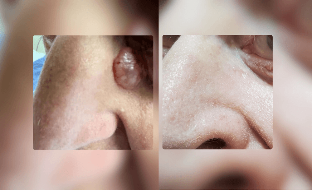 Successful Management of Basal Cell Carcinoma in a Challenging Location with a Multimodal Approach
