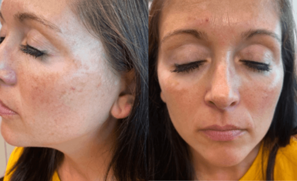 Successful Use of Ruxolitinib 1.5 Cream for Treatment of Nonsegmental