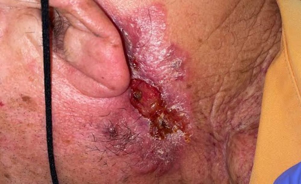 Accurately Assessing Prognosis for High-Risk Squamous Cell Carcinoma