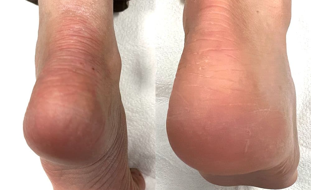 Atopic Dermatitis Heel After