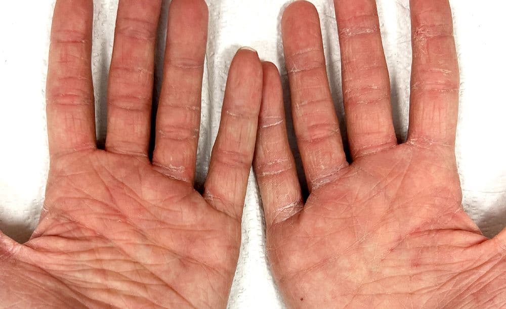 Case Atopic Derm Hands After