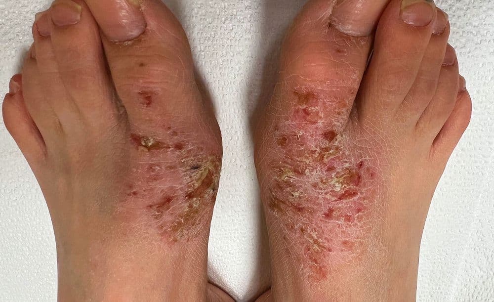 Description for feet After