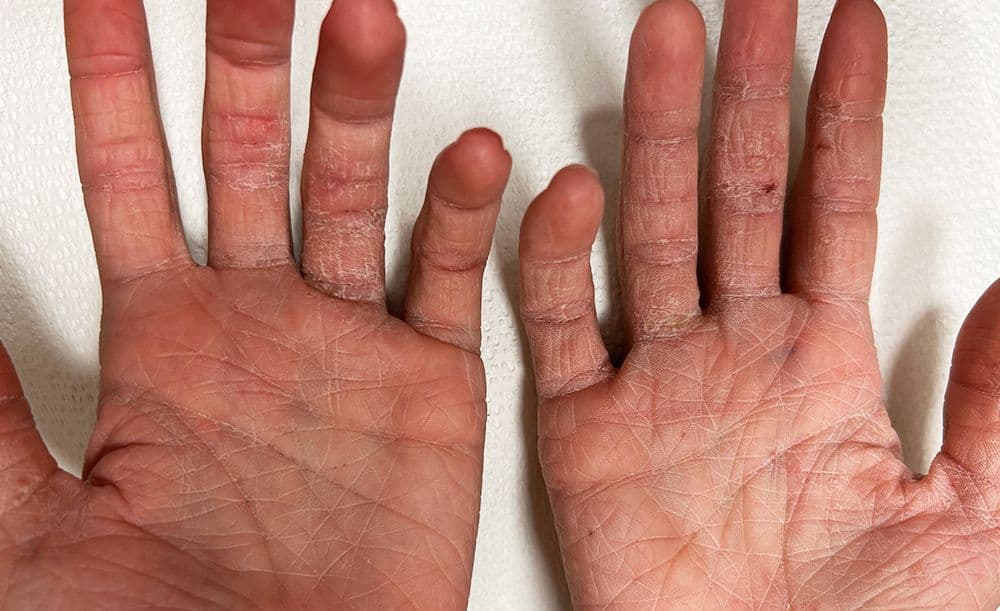 Case Atopic Derm Hands Before