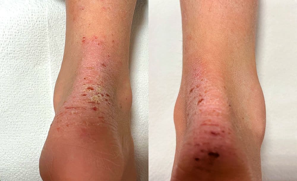 Atopic Dermatitis Heel Before