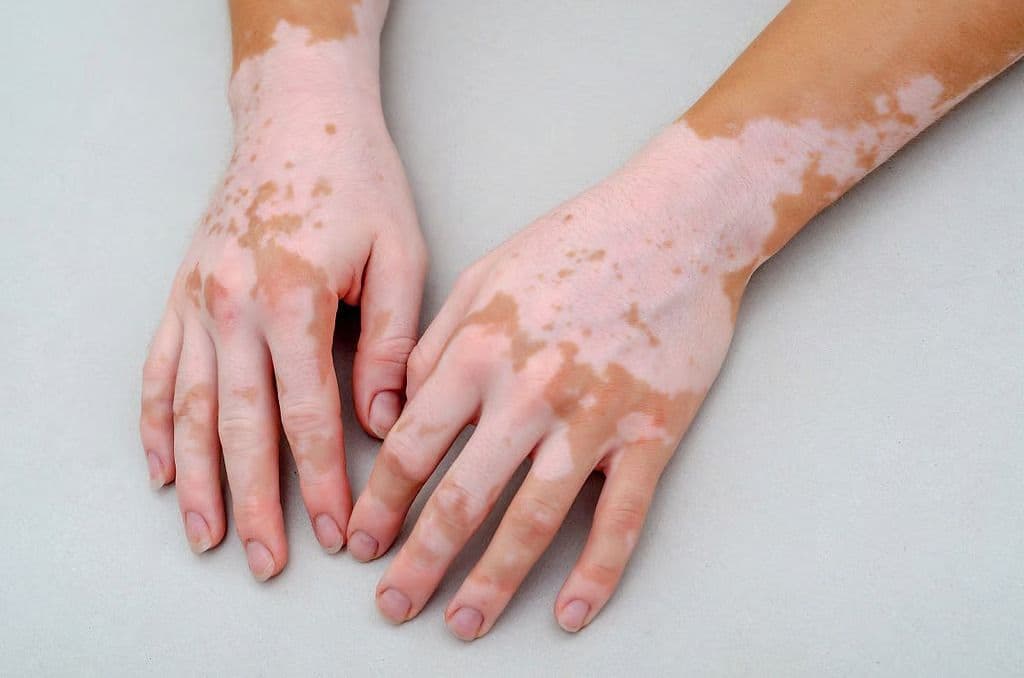 Image-Based System Reliable for Evaluating Vitiligo Lesions