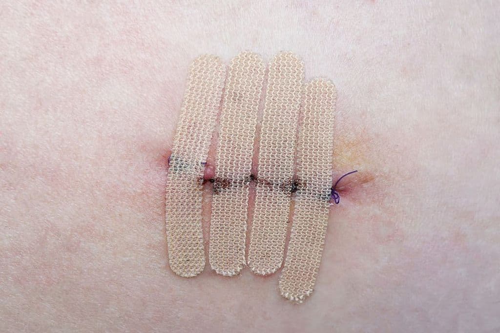 Extending Dabrafenib + Trametinib Beneficial in Stage III Melanoma