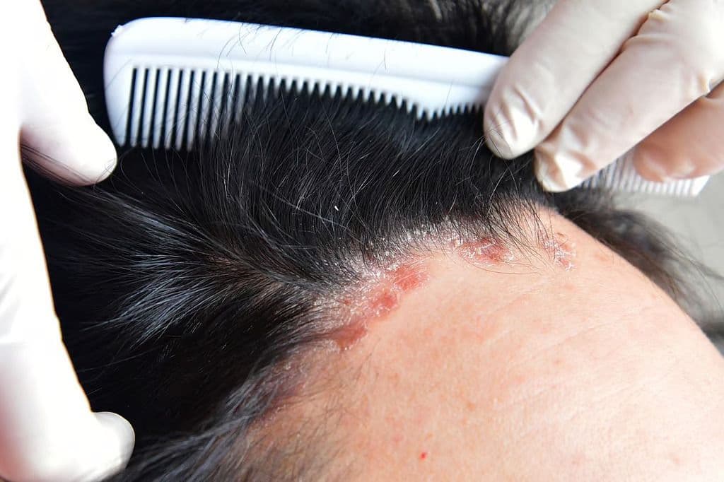Roflumilast Foam Improves Signs and Symptoms of Psoriasis