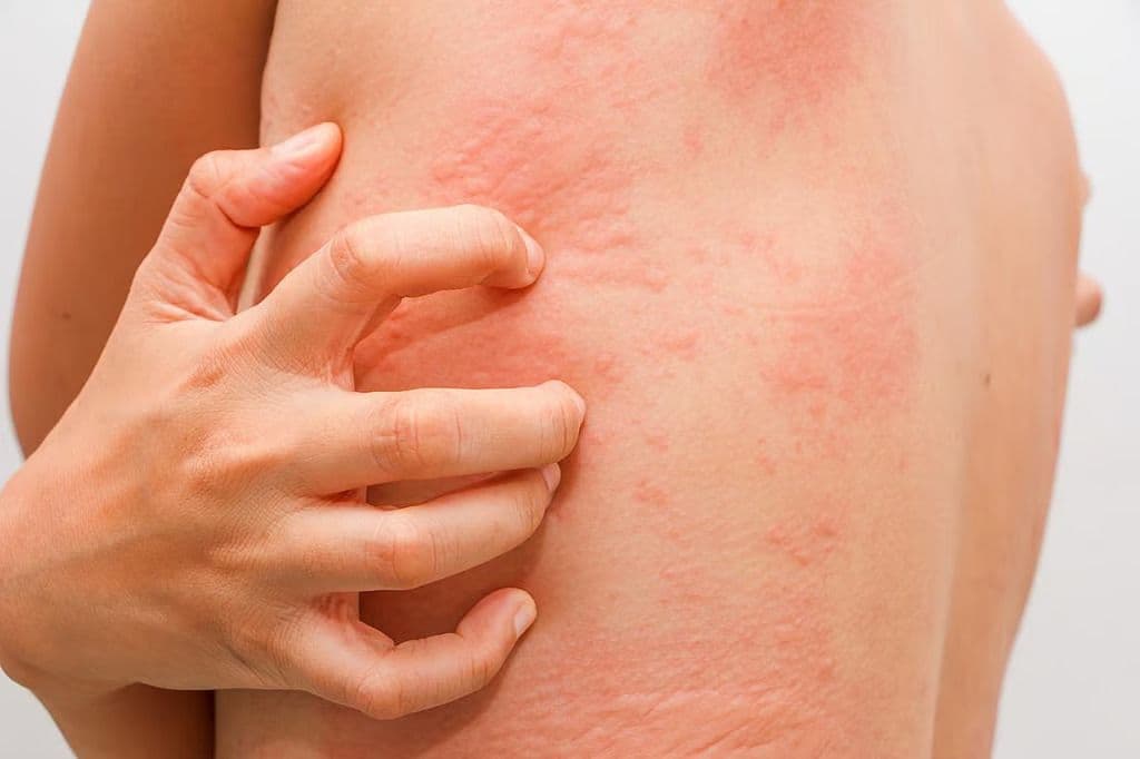 Urticaria Reported in Trial of Investigational HIV mRNA Vaccines
