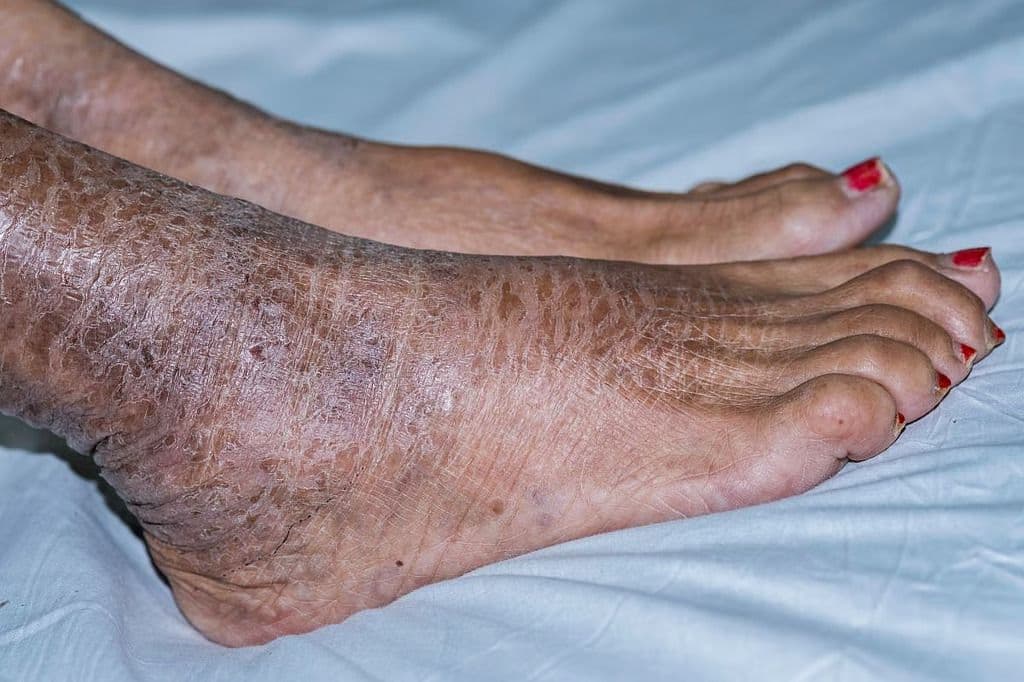Ichthyosis Scoring System Can Be Applied Across Phototypes