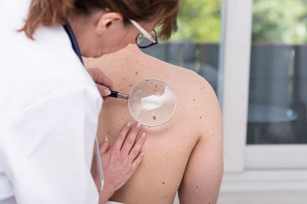 Melanoma Incidence and Deaths Disproportionately Impact Men