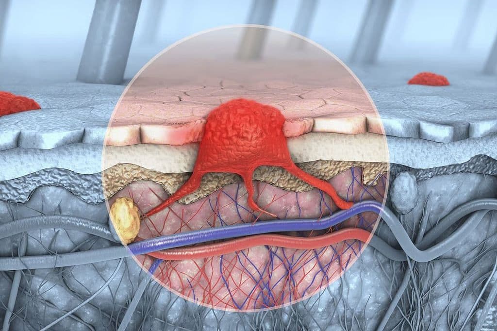 Second Course of Adjuvant Treatment Feasible in Stage III to IV Melanoma