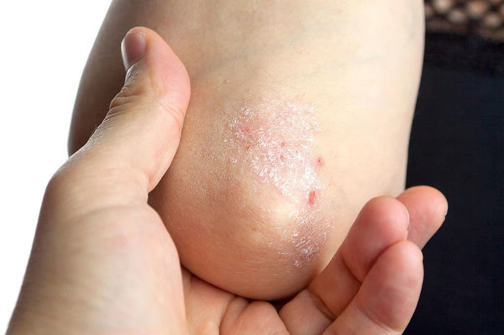 Plant-Based Diets May Aid Symptoms of Psoriasis