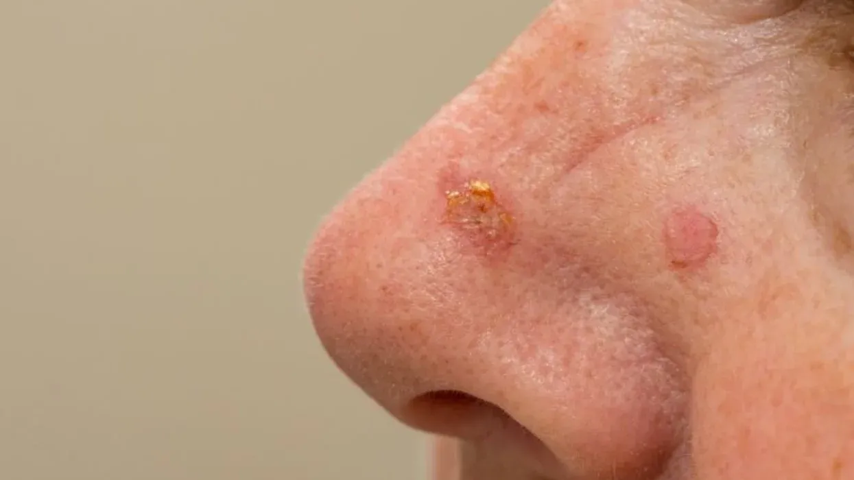 Is Tirbanibulin Effective for Treating Actinic Keratosis?