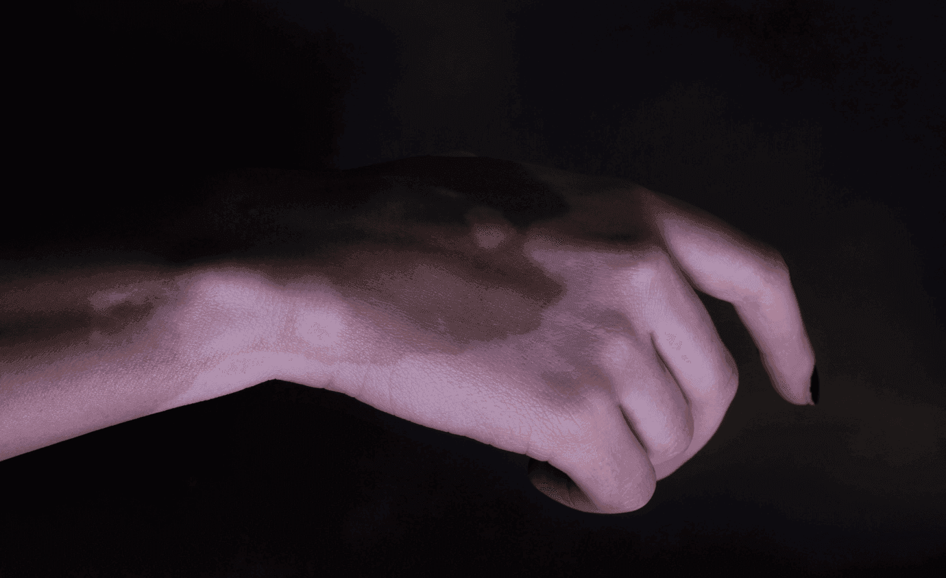 Exploring the Comorbidities Associated with Vitiligo 