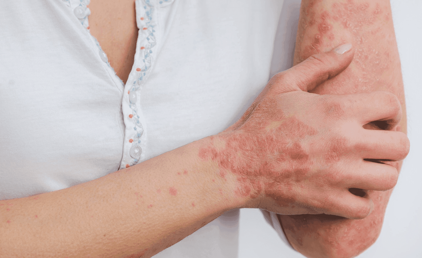 LAUNCH ALERT: Bimzelx Approved For Moderate-to-Severe Plaque psoriasis