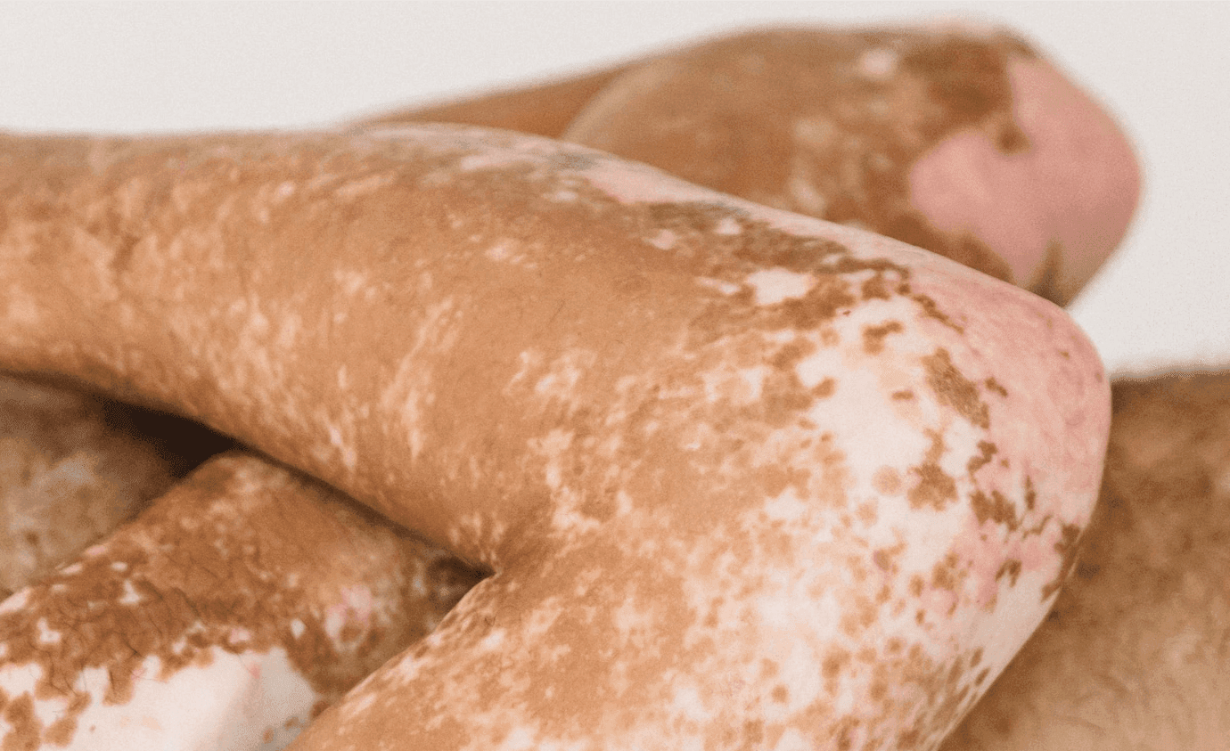 Update on Pathogenesis of Vitiligo