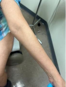 4 months after SC Spesolimab