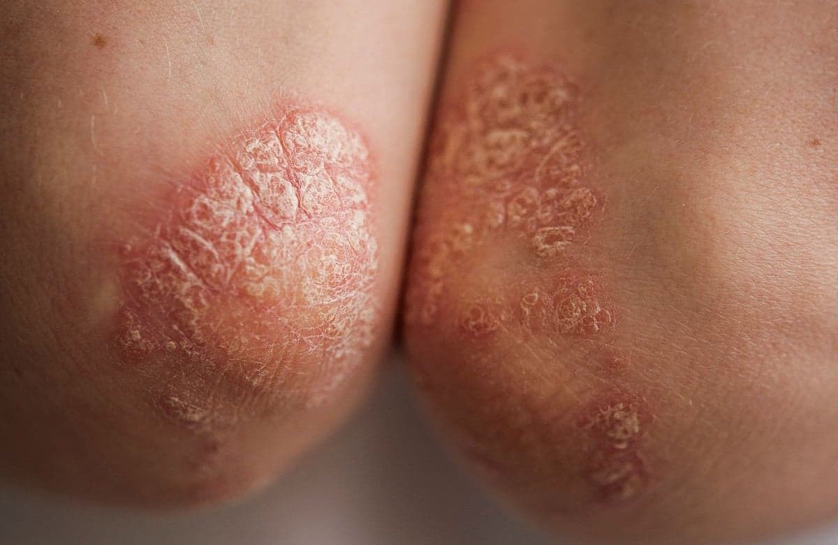 EADV: Oral Zasocitinib Beneficial for Adults With Plaque Psoriasis