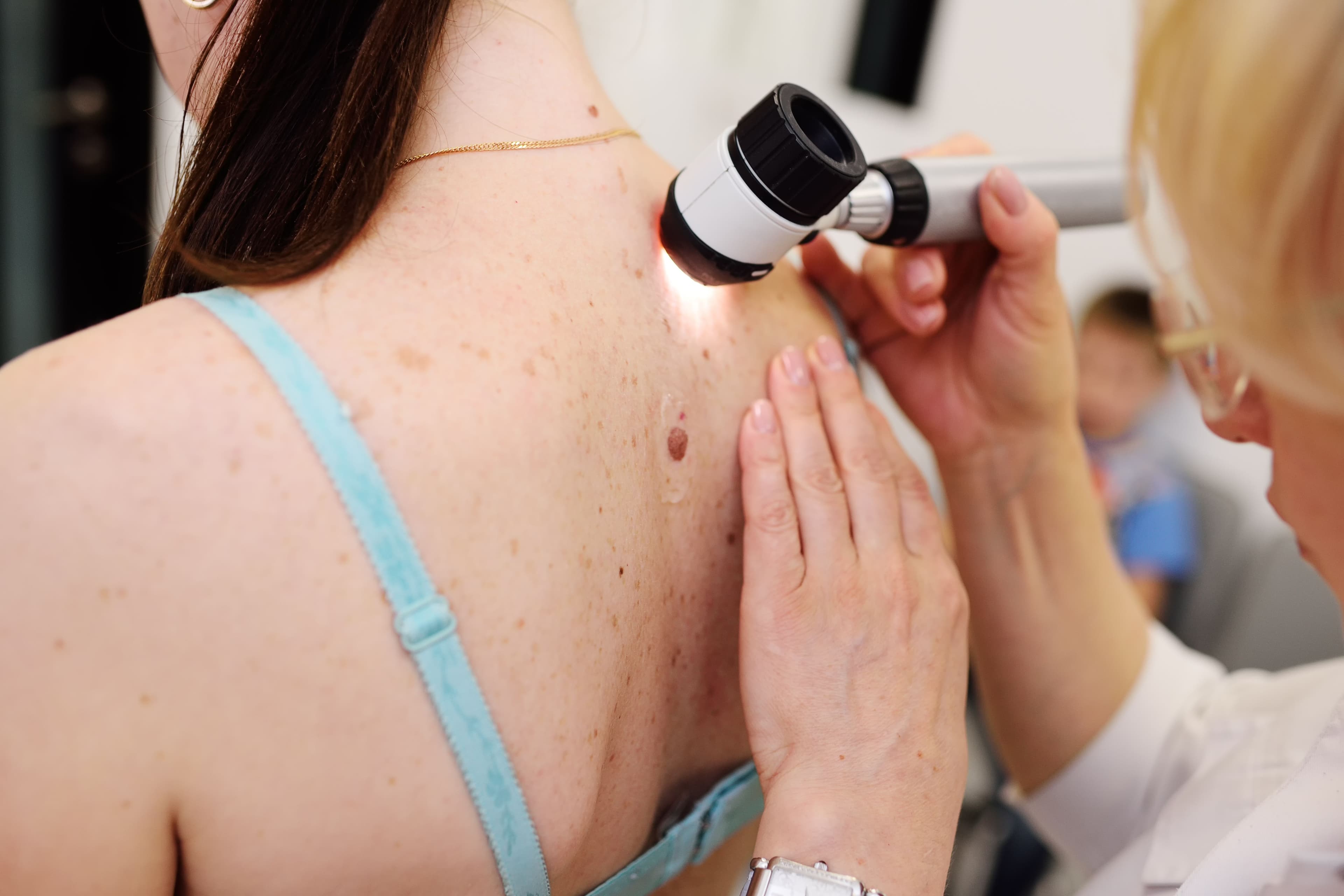 Melanoma Monday: Transforming Lives Through Early Detection and Prevention