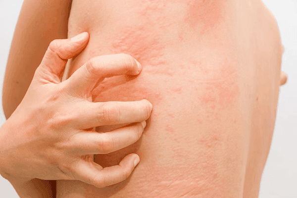Remibrutinib Beneficial for Urticaria After H1-Antihistamine Treatment