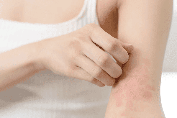 Dietary Vitamin E May Be Protective Against Atopic Dermatitis