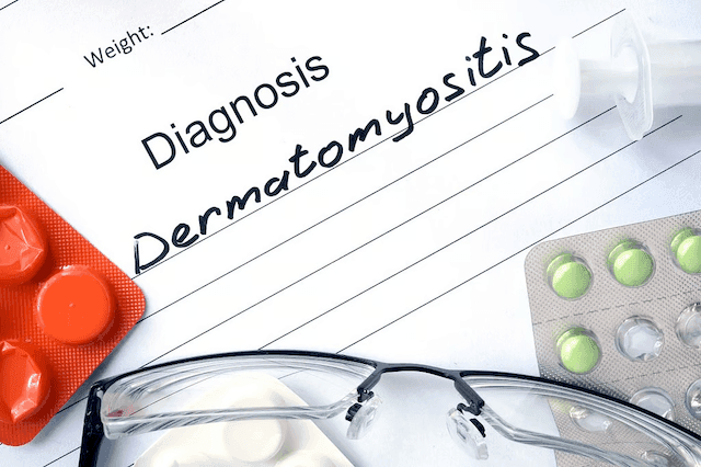 Dermatomyositis, Clinically Amyopathic Dermatomyositis Often Misdiagnosed