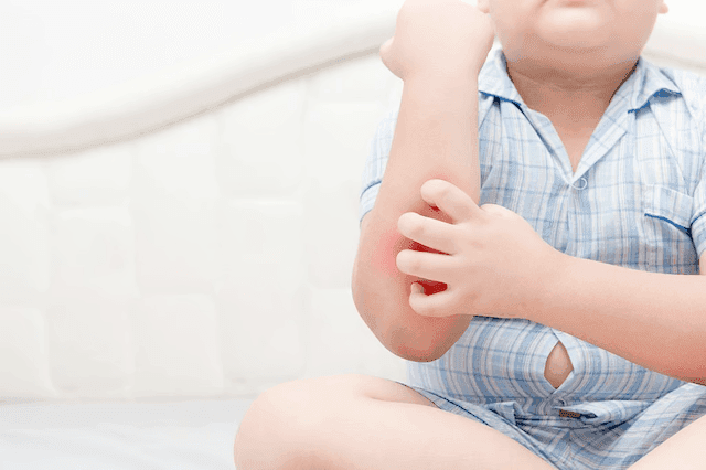 Children With Obesity Have Increased Rates of Dermatologic Conditions