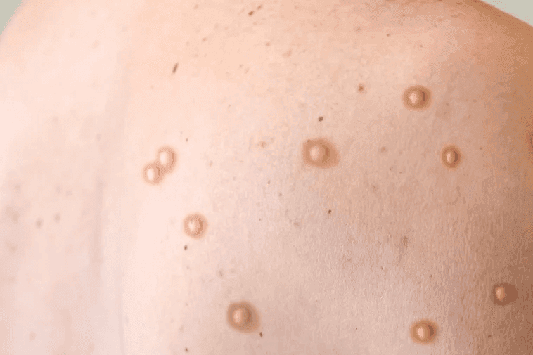 Skin Lesions Often First Sign of Mpox Infection in 2022 Outbreak