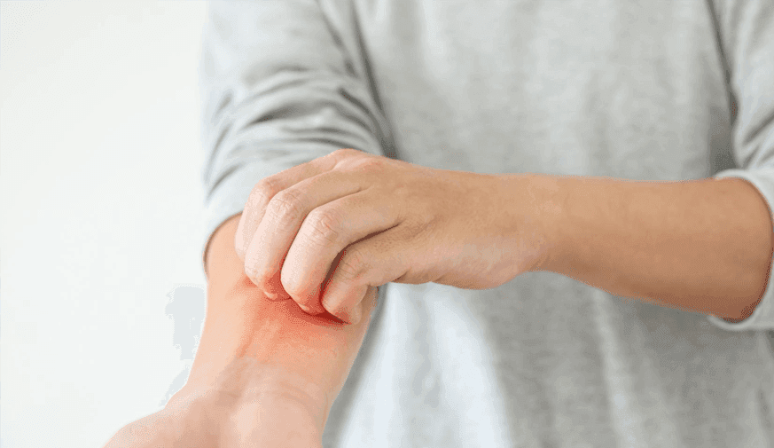 Updated Guidelines Released for Management of Atopic Dermatitis