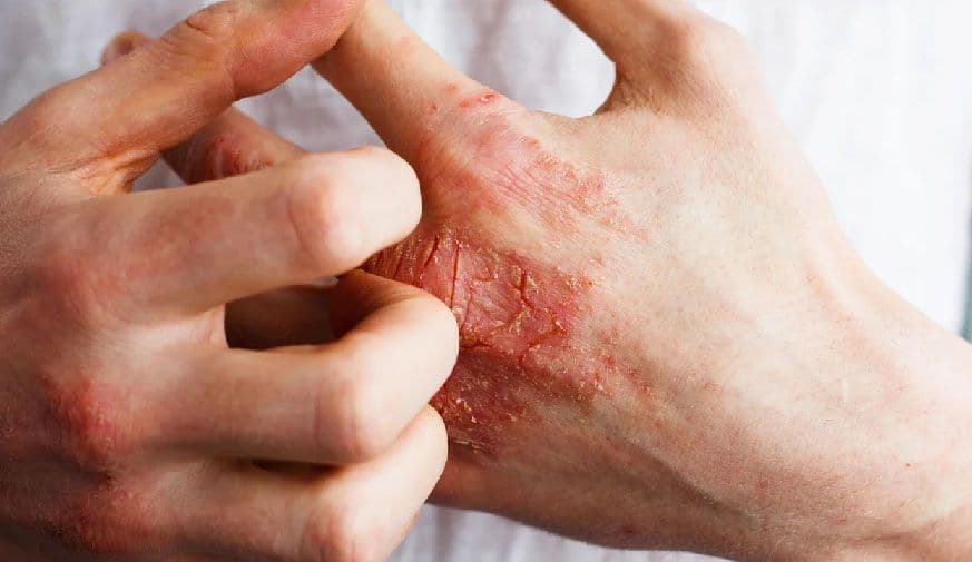 Long-Term Efficacy for Lebrikizumab Seen in Moderate, Severe Eczema