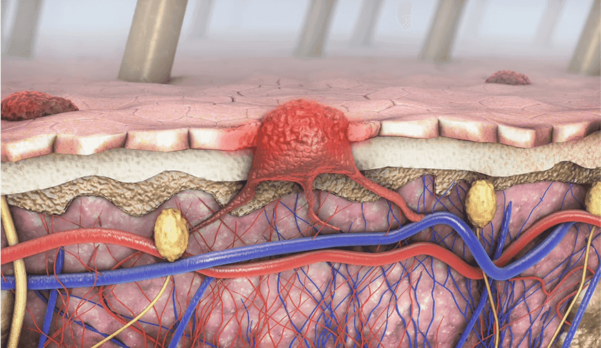 Distinct Recurrence Patterns Seen for Primary, Relapsed Cutaneous Melanoma