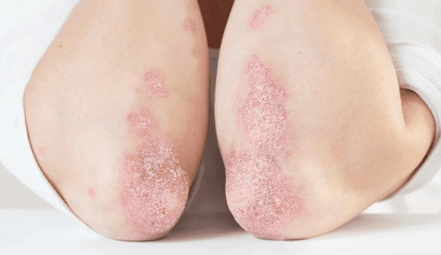Coronary Microvascular Dysfunction ID'd in 31.5 Percent With Psoriasis