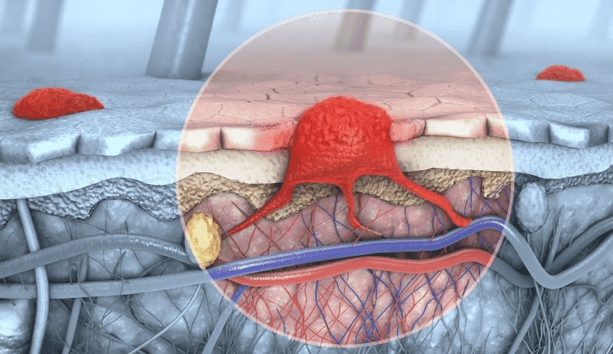 AAD: Risk for Second Primary Malignancy Increased for Melanoma Patients
