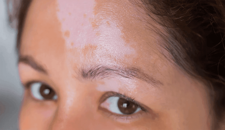 Risk for Vitiligo Increased for Transplant Recipients