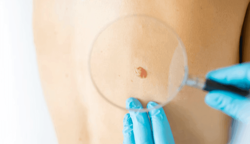 New Set of Risk Factors Can Boost Detection of Suspicious Skin Lesions