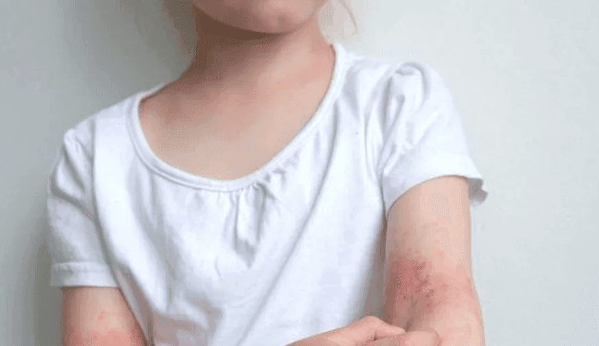 Children With Eczema More Likely to Have Allergic Contact Dermatitis