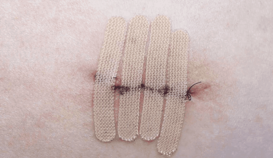 Microdosed Incisional Clindamycin Cuts SSI After Skin Cancer Surgery