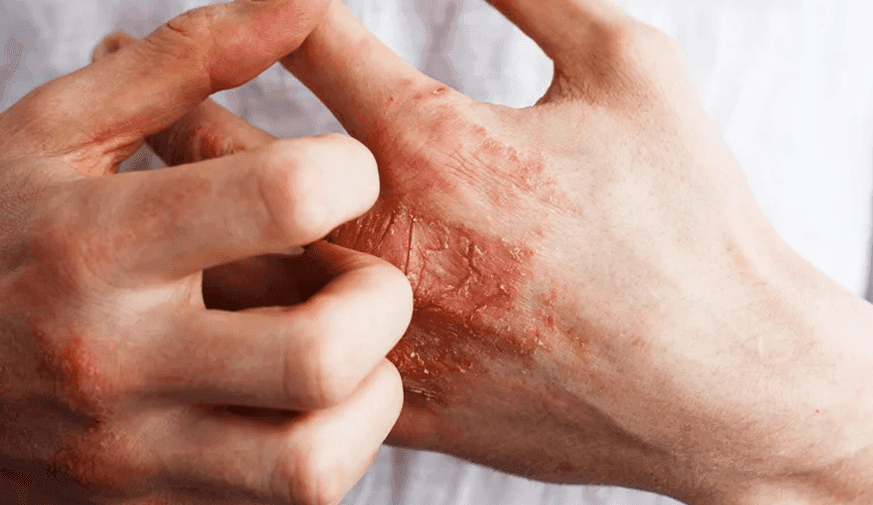 Skin Diseases Pose a Psychosocial Burden