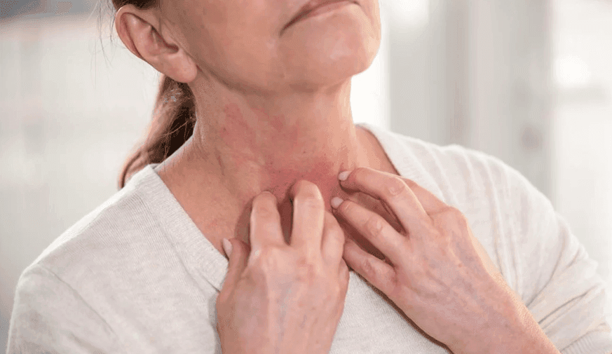 Metformin Use Not Significantly Linked to Pruritus