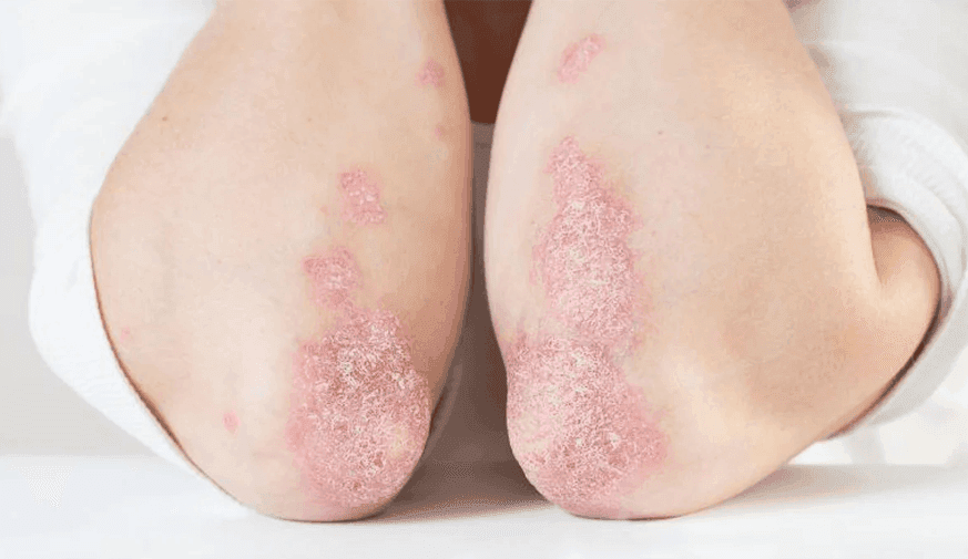 Brepocitinib Beneficial for Moderate-to-Severe Psoriatic Arthritis