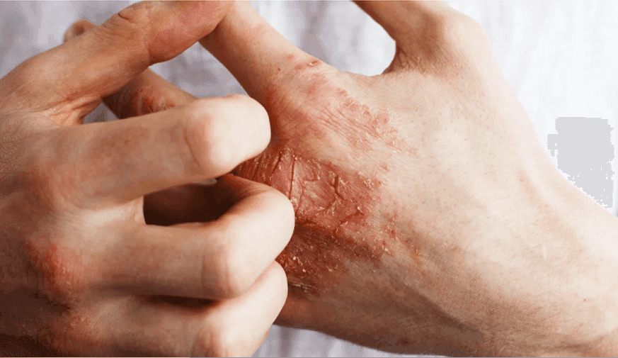 Chronic Hand Eczema Rapidly Improves With Gusacitinib