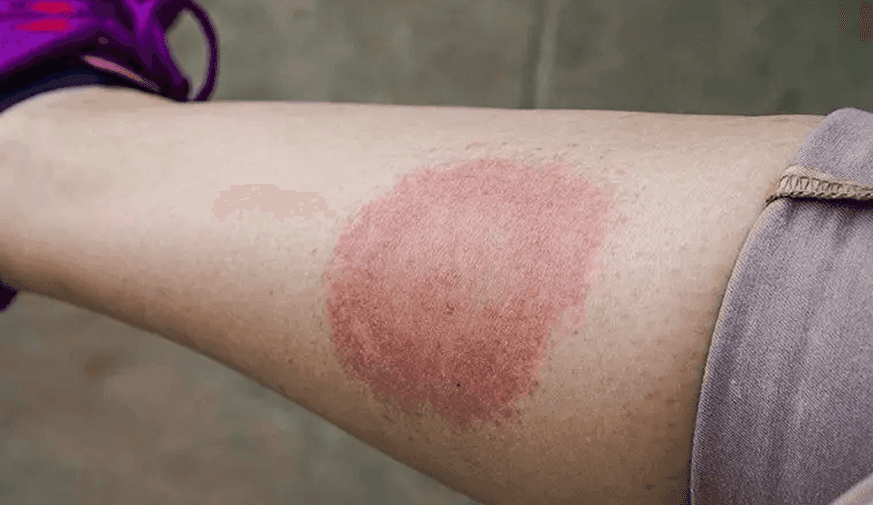 Blacks More Likely to Have Disseminated Manifestations of Lyme Disease