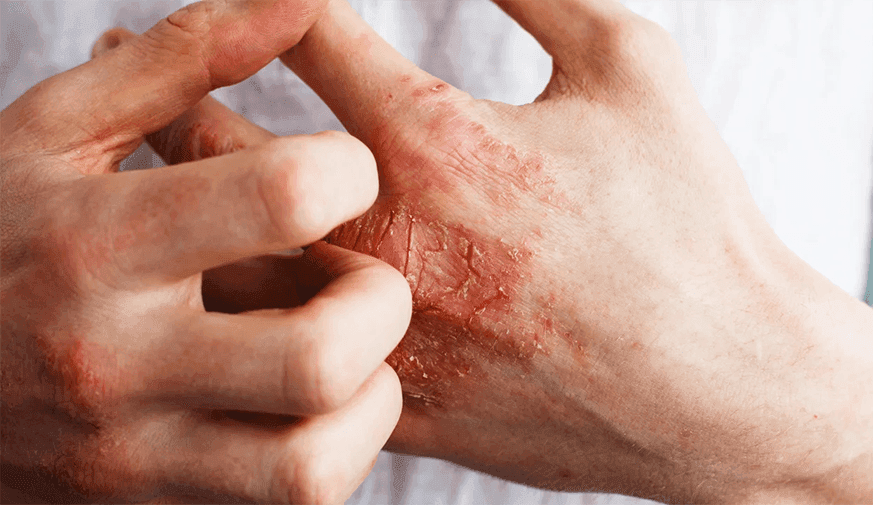 Does UVB Phototherapy Increase Risk for Skin Cancer in Patients With Eczema?