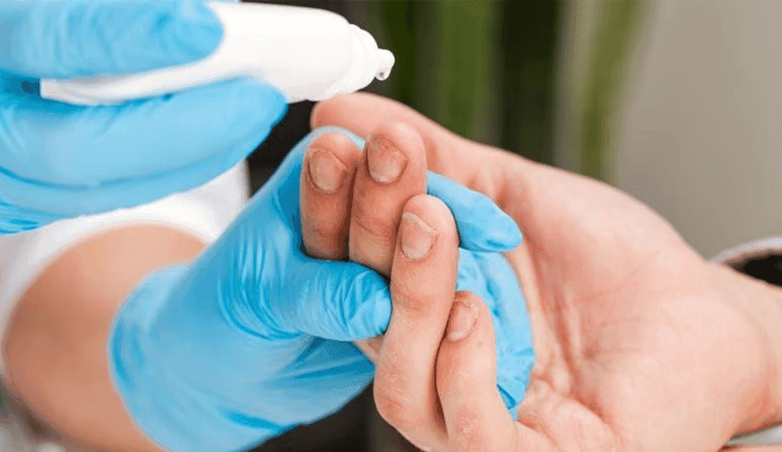 Individuals With BAP1 Have High Rate of Nail Abnormalities
