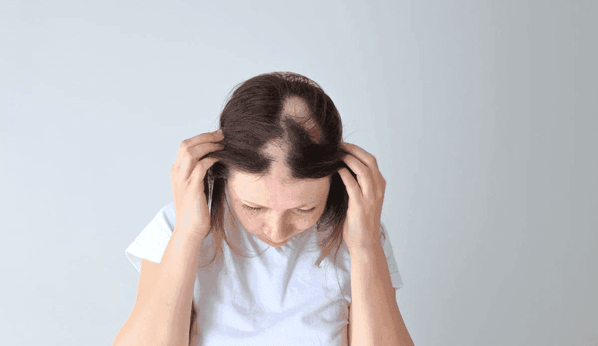 Alopecia Tied to Higher Prevalence of Autoimmune, Psychiatric Comorbidities
